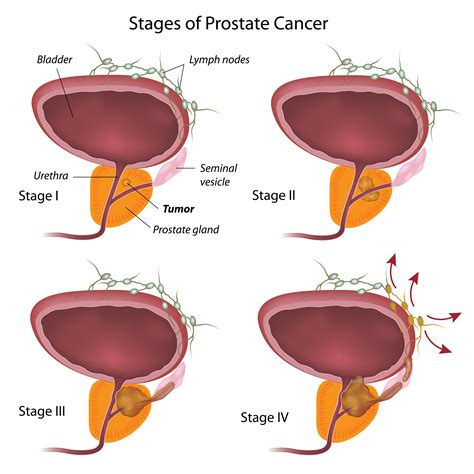 There are two types of orchiectomy. . Orchiectomy for enlarged prostate